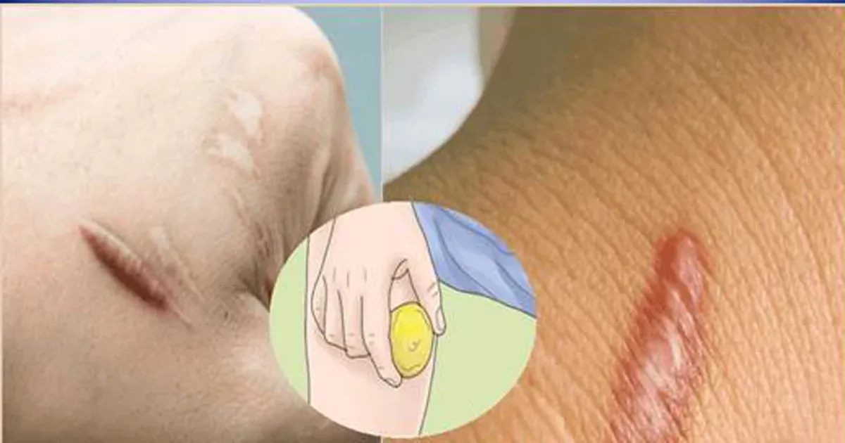 (5) secrets that will completely heal old scars that have been around for years