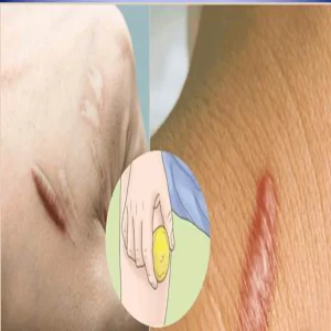 (5) secrets that will completely heal old scars that have been around for years