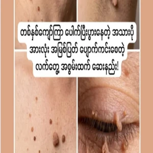A method that completely cures all excess skin that has been growing for more than a year